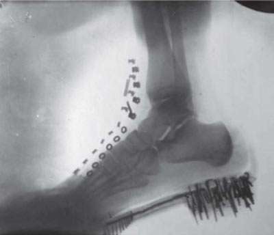 Tesla's x-ray of a foot