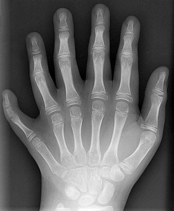 x-ray of a six digit hand with fully formed fingers